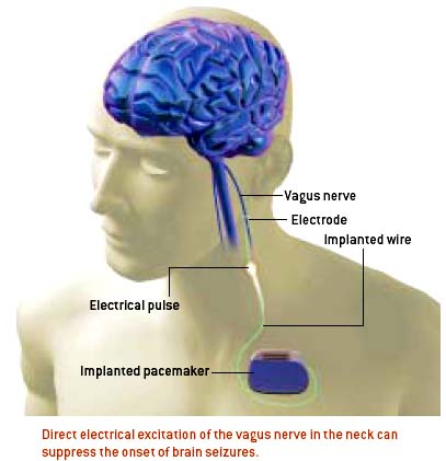 Surgeons typically wrap the VNS electrode around the left Vagus nerve in the 